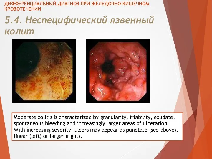 5.4. Неспецифический язвенный колит ДИФФЕРЕНЦИАЛЬНЫЙ ДИАГНОЗ ПРИ ЖЕЛУДОЧНО-КИШЕЧНОМ КРОВОТЕЧЕНИИ Moderate