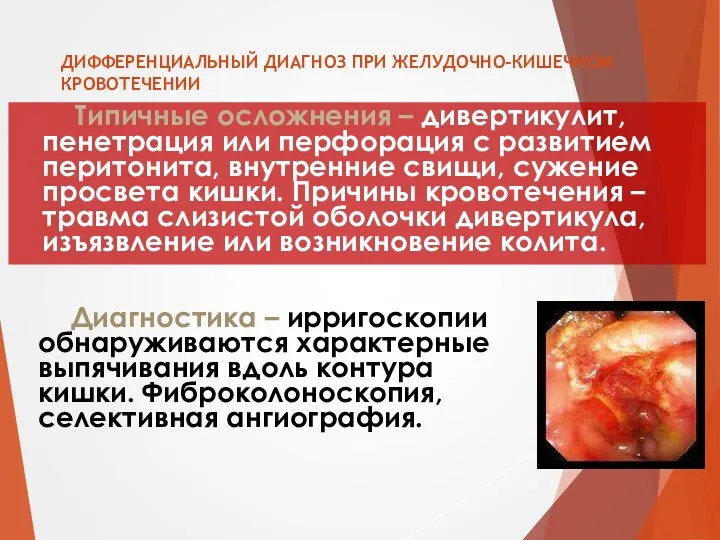 ДИФФЕРЕНЦИАЛЬНЫЙ ДИАГНОЗ ПРИ ЖЕЛУДОЧНО-КИШЕЧНОМ КРОВОТЕЧЕНИИ Типичные осложнения – дивертикулит, пенетрация