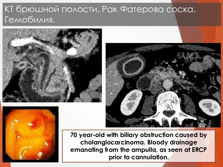 70 year-old with biliary obstruction caused by cholangiocarcinoma. Bloody drainage