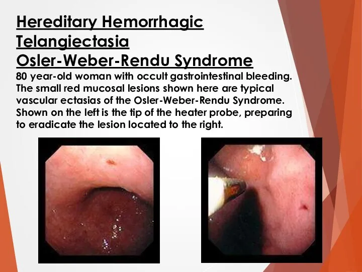 Hereditary Hemorrhagic Telangiectasia Osler-Weber-Rendu Syndrome 80 year-old woman with occult