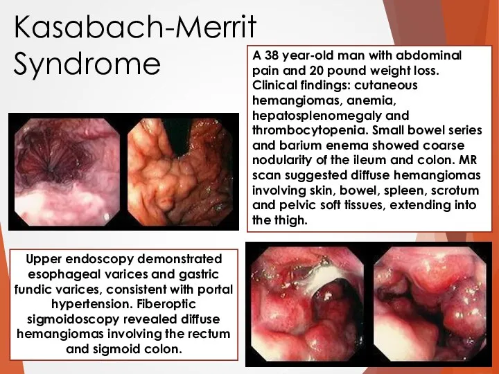 A 38 year-old man with abdominal pain and 20 pound