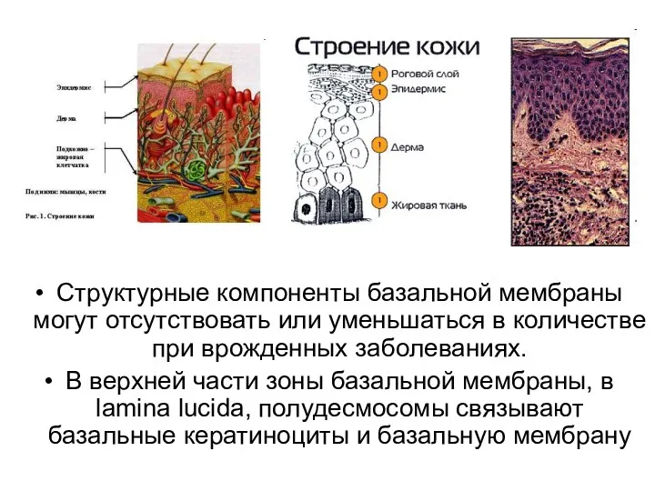 Структурные компоненты базальной мембраны могут отсутствовать или уменьшаться в количестве