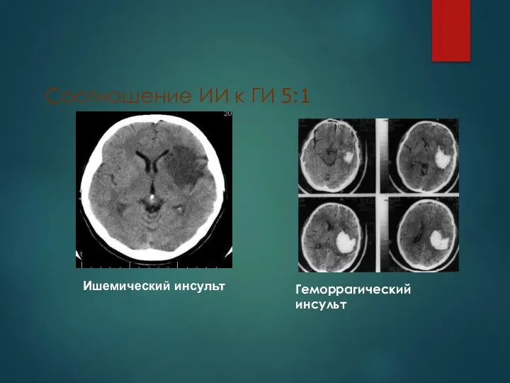 Соотношение ИИ к ГИ 5:1 Ишемический инсульт Геморрагический инсульт