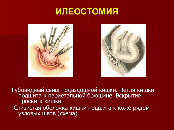 ИЛЕОСТОМИЯ Губовидный свищ подвздошной кишки. Петля кишки подшита к париетальной