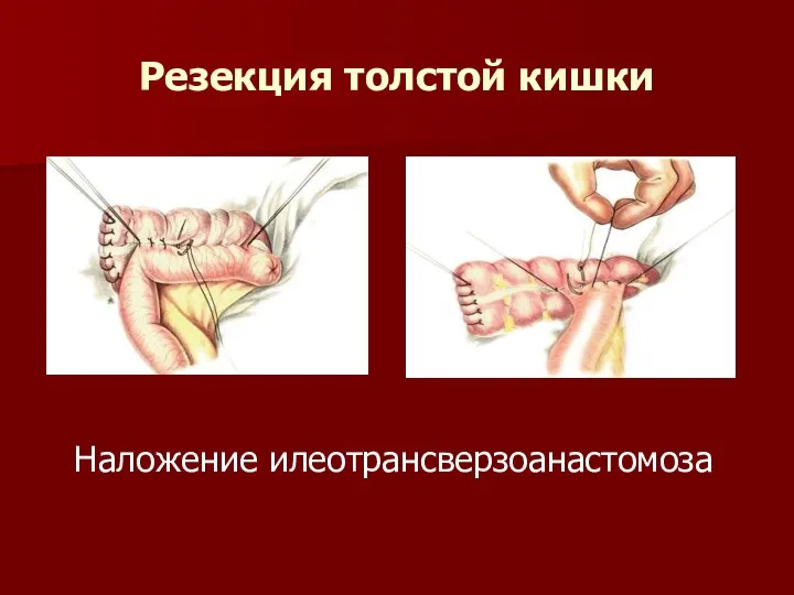 Резекция толстой кишки Наложение илеотрансверзоанастомоза