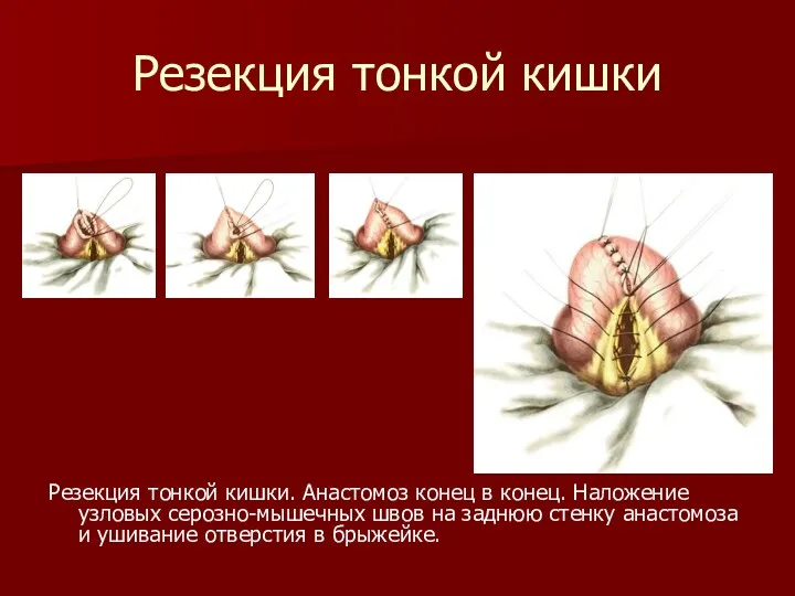 Резекция тонкой кишки Резекция тонкой кишки. Анастомоз конец в конец.