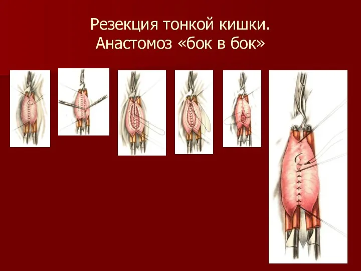 Резекция тонкой кишки. Анастомоз «бок в бок»