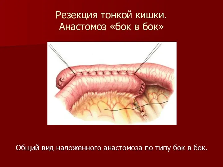 Резекция тонкой кишки. Анастомоз «бок в бок» Общий вид наложенного анастомоза по типу бок в бок.