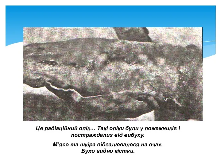 Це радіаційний опік… Такі опіки були у пожежників і постраждалих