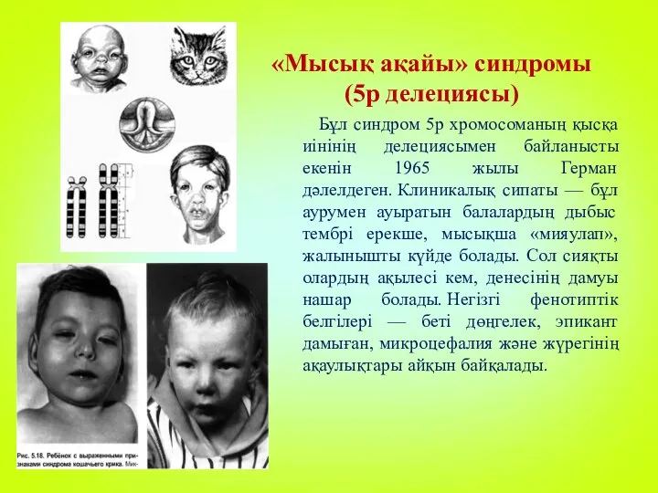 «Мысық ақайы» синдромы (5р делециясы) Бұл синдром 5р хромосоманың қысқа