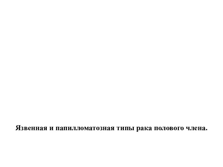 Язвенная и папилломатозная типы рака полового члена.