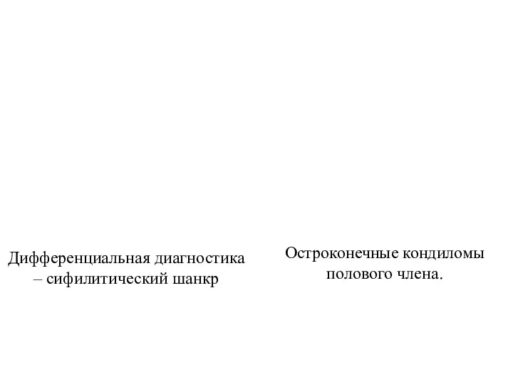 Дифференциальная диагностика – сифилитический шанкр Остроконечные кондиломы полового члена.