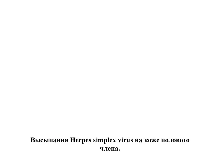 Высыпания Herpes simplex virus на коже полового члена.