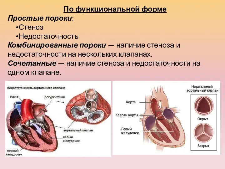 По функциональной форме Простые пороки: Стеноз Недостаточность Комбинированные пороки —