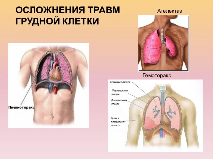 Ателектаз Гемоторакс ОСЛОЖНЕНИЯ ТРАВМ ГРУДНОЙ КЛЕТКИ