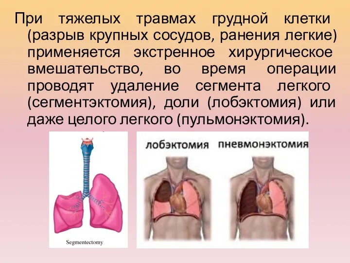 При тяжелых травмах грудной клетки (разрыв крупных сосудов, ранения легкие)