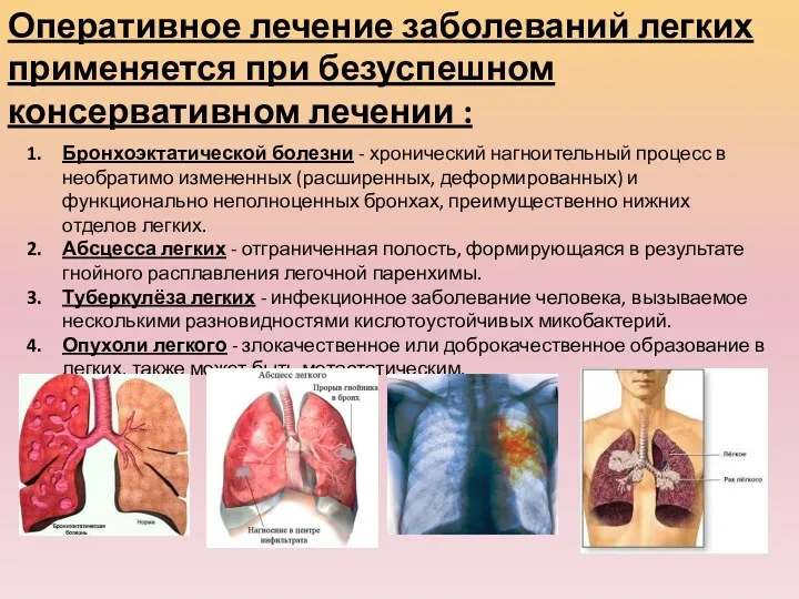 Оперативное лечение заболеваний легких применяется при безуспешном консервативном лечении :