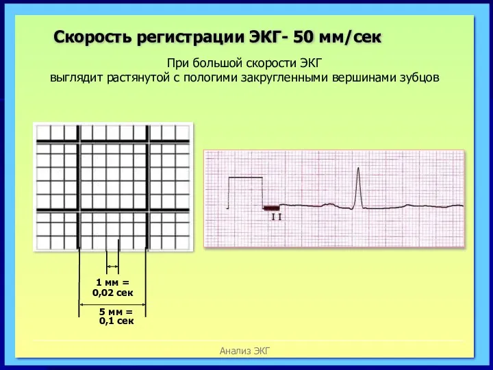 Анализ ЭКГ Скорость регистрации ЭКГ- 50 мм/сек При большой скорости ЭКГ выглядит растянутой