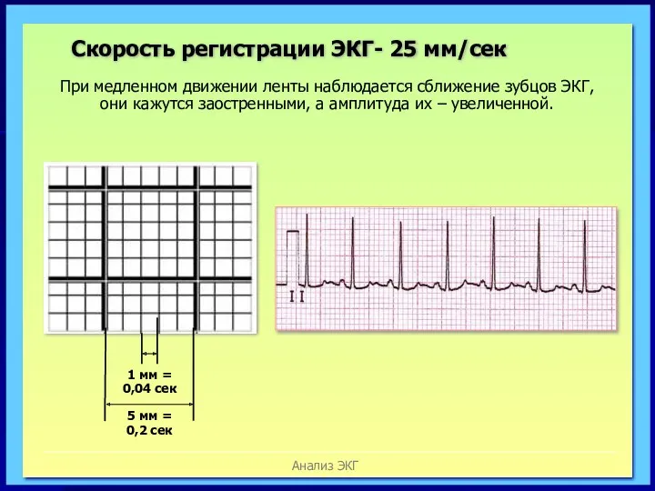 Анализ ЭКГ При медленном движении ленты наблюдается сближение зубцов ЭКГ,