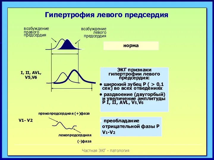 Частная ЭКГ - патология Гипертрофия левого предсердия возбуждение правого предсердия возбуждение левого предсердия