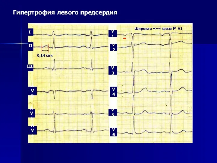 Гипертрофия левого предсердия 0,14 сек Широкая «–» фаза Р V1