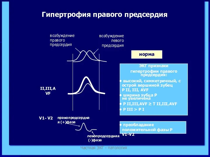 Частная ЭКГ - патология возбуждение правого предсердия возбуждение левого предсердия II,III,AVF норма ЭКГ