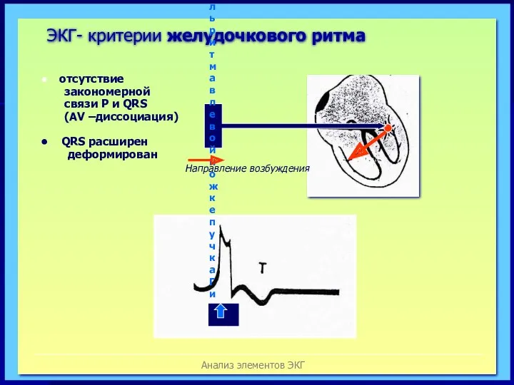 Анализ элементов ЭКГ ЭКГ- критерии желудочкового ритма водитель ритма в левой ножке пучка