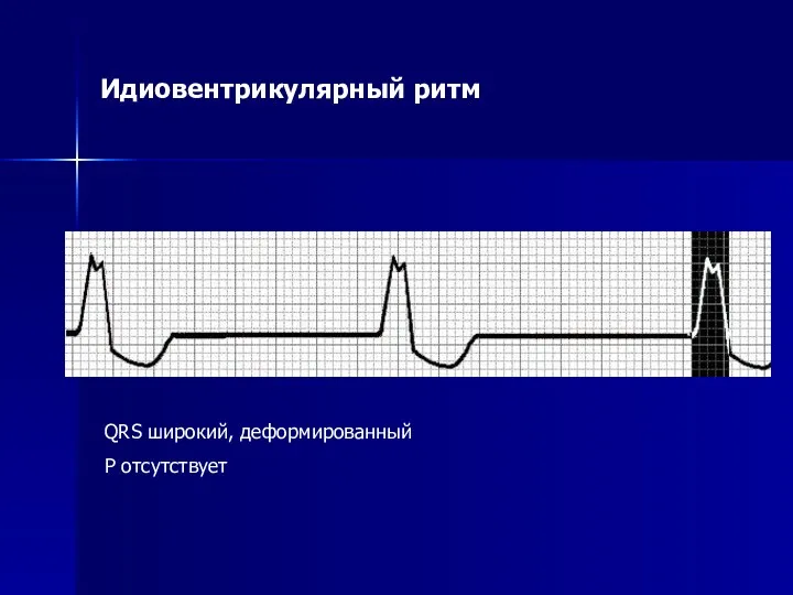 Идиовентрикулярный ритм QRS широкий, деформированный Р отсутствует