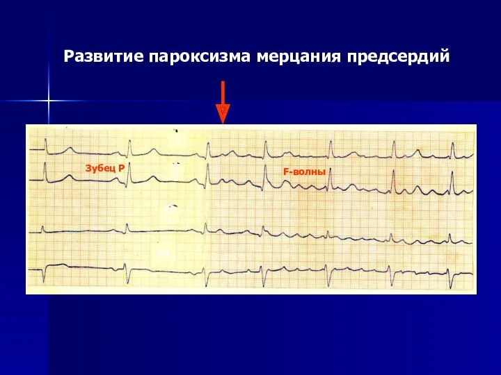 Развитие пароксизма мерцания предсердий I II III V1 Зубец Р F-волны