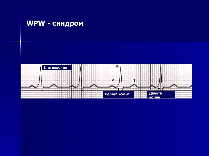 WPW - синдром I отведение Дельта волна Дельта волна