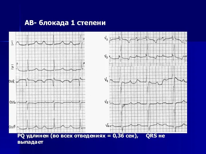 АВ- блокада 1 степени PQ удлинен (во всех отведениях = 0,36 сек), QRS не выпадает