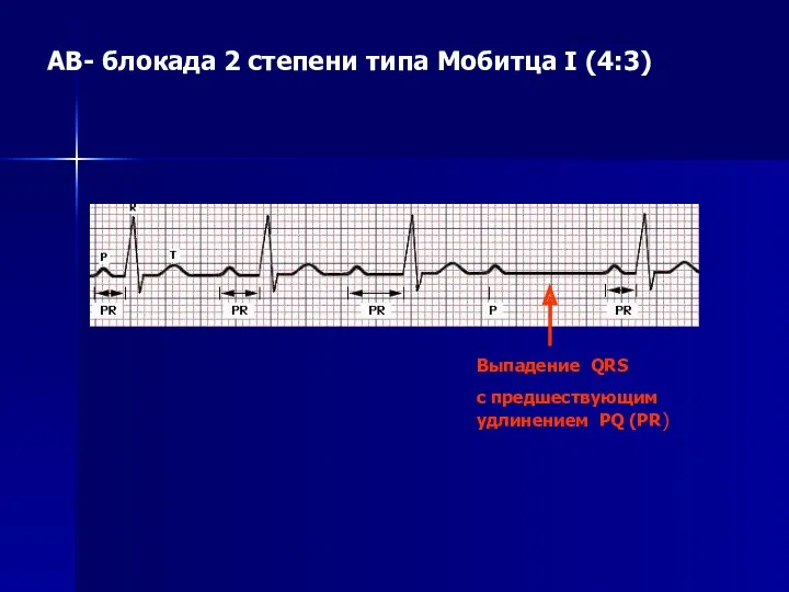 AВ- блокада 2 степени типа Мобитца I (4:3) Выпадение QRS c предшествующим удлинением PQ (PR)