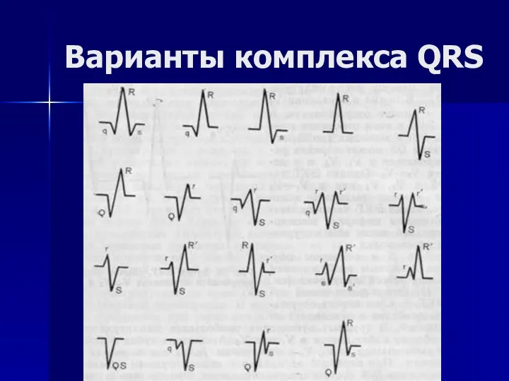 Варианты комплекса QRS