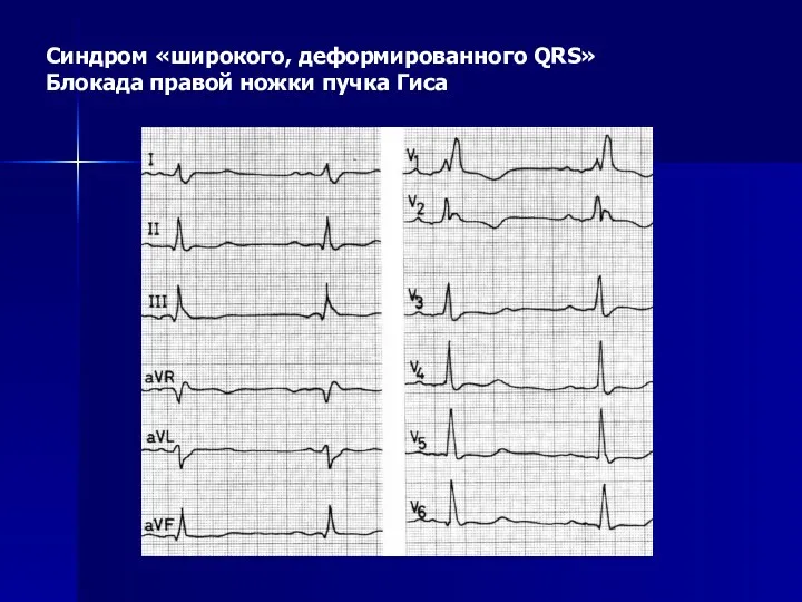 Синдром «широкого, деформированного QRS» Блокада правой ножки пучка Гиса