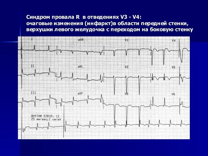 Синдром провала R в отведениях V3 - V4: очаговые изменения (инфаркт)в области передней