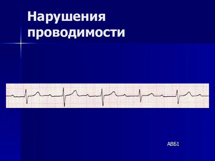 Нарушения проводимости АВБ1