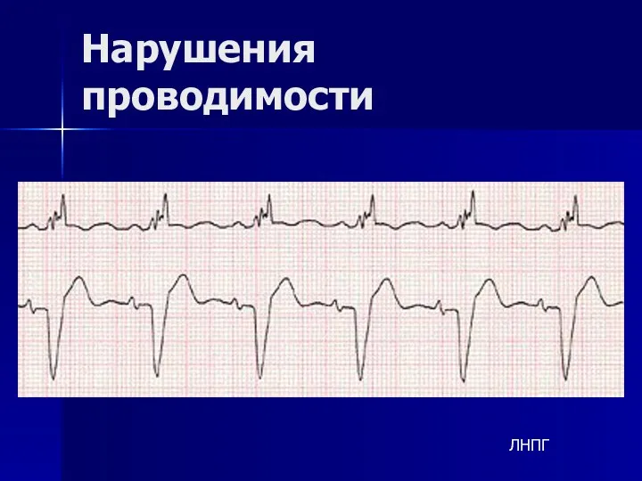 Нарушения проводимости ЛНПГ