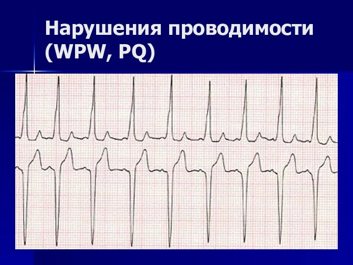 Нарушения проводимости (WPW, PQ)