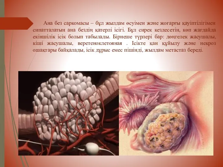 Ана без саркомасы – бұл жылдам өсуімен және жоғарғы қауіптілігімен