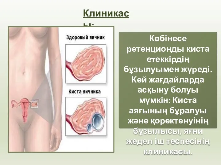 Клиникасы: Көбінесе ретенционды киста етеккірдің бұзылуымен жүреді. Кей жағдайларда асқыну