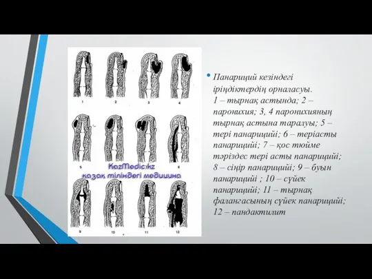 Панариций кезіндегі іріңдіктердің орналасуы. 1 – тырнақ астында; 2 –