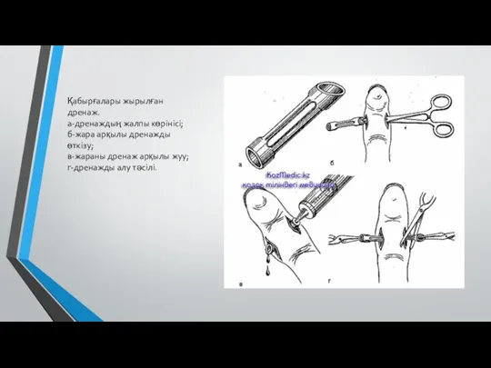 Қабырғалары жырылған дренаж. а-дренаждың жалпы көрінісі; б-жара арқылы дренажды өткізу; в-жараны дренаж арқылы