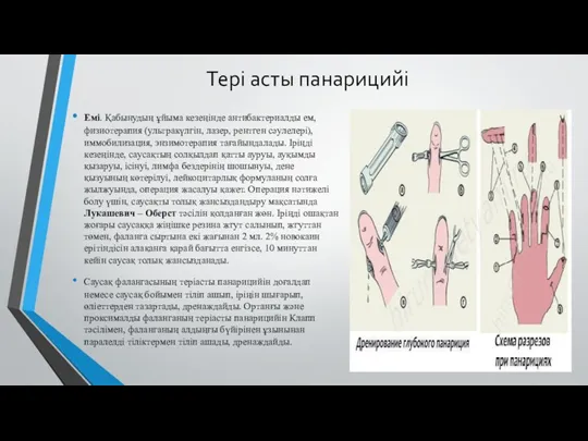 Тері асты панарицийі Емі. Қабынудың ұйыма кезеңінде антибактериалды ем, физиотерапия