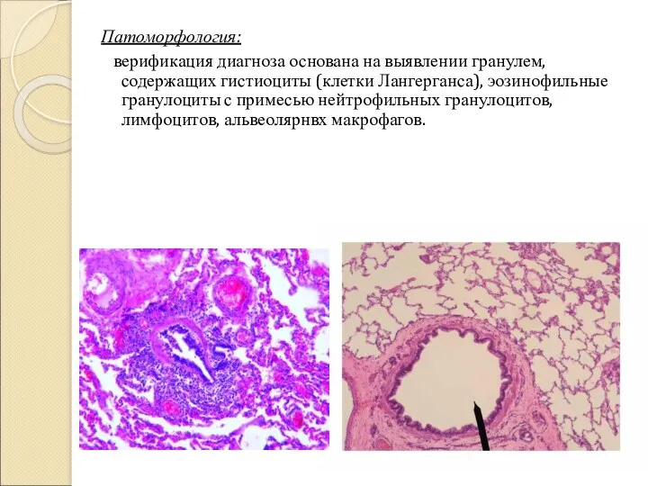 Патоморфология: верификация диагноза основана на выявлении гранулем, содержащих гистиоциты (клетки