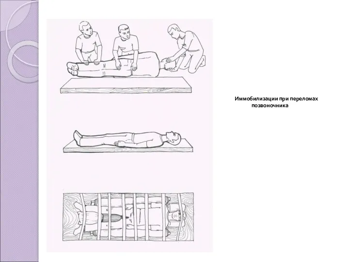Иммобилизации при переломах позвоночника