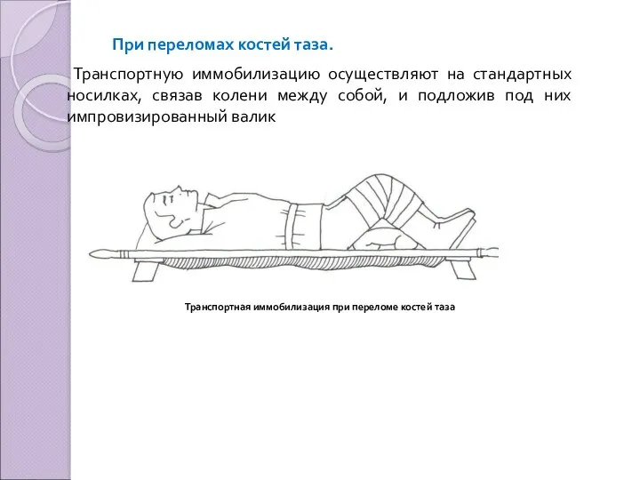 При переломах костей таза. Транспортную иммобилизацию осуществляют на стандартных носилках,