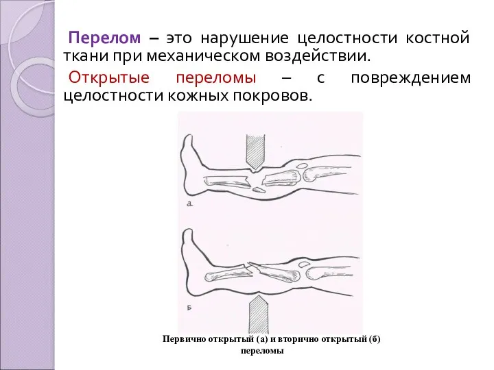 Перелом – это нарушение целостности костной ткани при механическом воздействии.