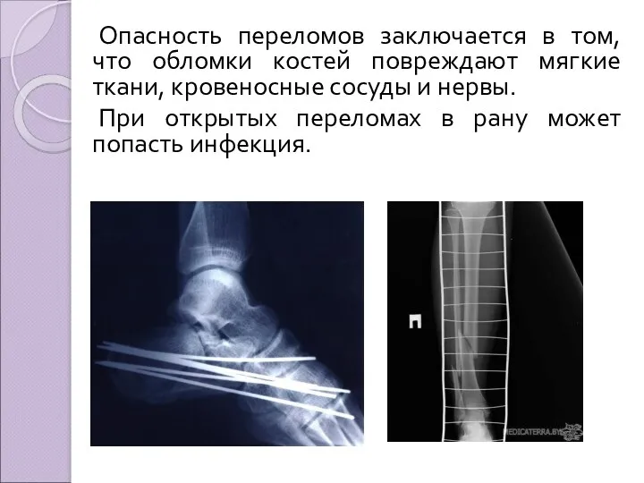 Опасность переломов заключается в том, что обломки костей повреждают мягкие