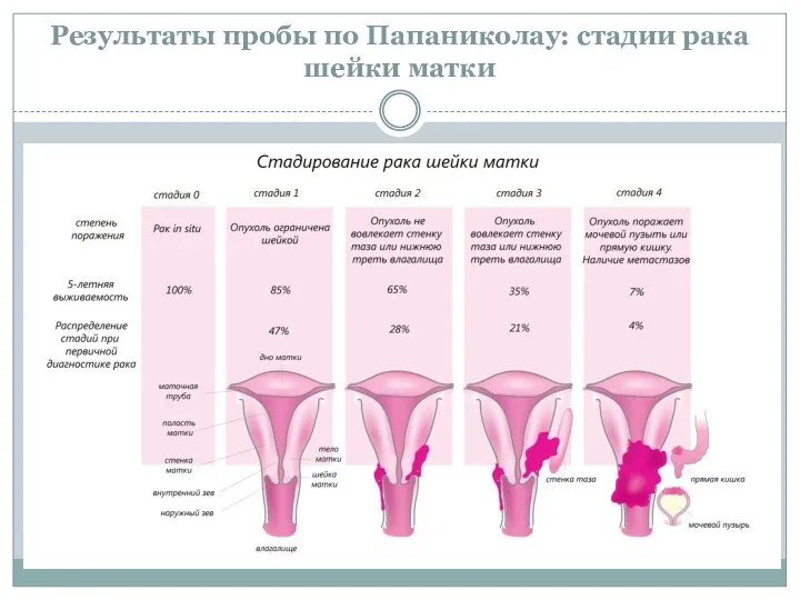Результаты пробы по Папаниколау: стадии рака шейки матки