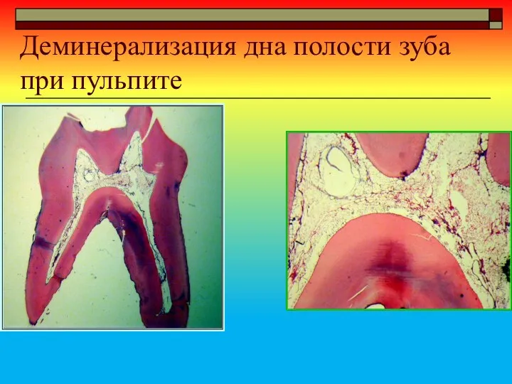 Деминерализация дна полости зуба при пульпите